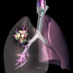 cancer pulmonar