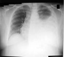 derrame pleural