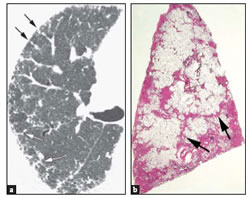 Enfermedades del Intersticio Pulmonar