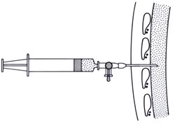 Toracocentesis