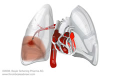 Tromboembolia Pulmonar: