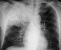 tuberculosis pulmonar